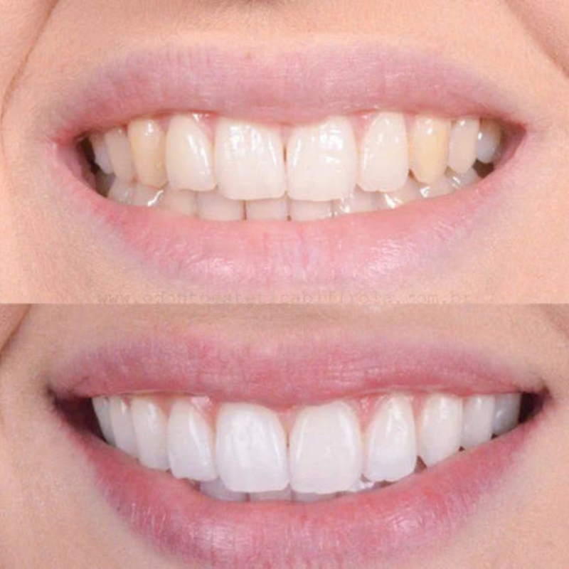 Descoloração dental rápida para um sorriso radiante 